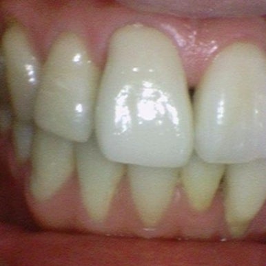 앞니 하나가 부러졌어요 앞니 크라운 앞니 브릿지 관련 이미지 2