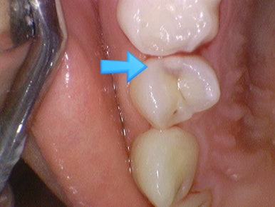[서울시청역] 눈에 보이지 않는 충치 실제사진 관련 이미지 9