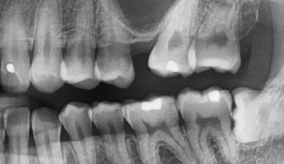 [서울시청역치과] 20대, 30대도 임플란트를 하나요?? +네비게이션임플란트안내 관련 이미지 3