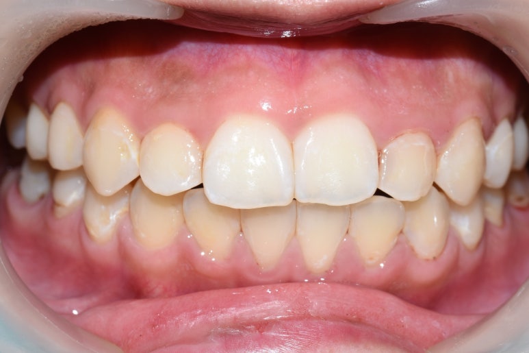 [서울역/시청역] 충치 & 화이트 스팟 (반점치) 의 레진치료케이스 관련 이미지 4