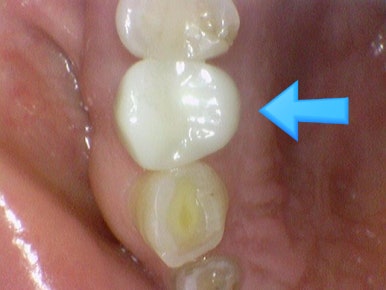 치아가 충치나 크랙으로 지르코니아 크라운을 해야한다면? 구강스캔사용치과의 지르코니아크라운 설명 관련 이미지 5