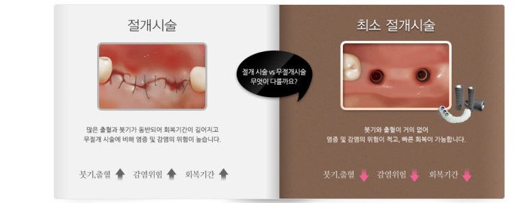 No incision Navigation implant , Seoul 관련 이미지 5