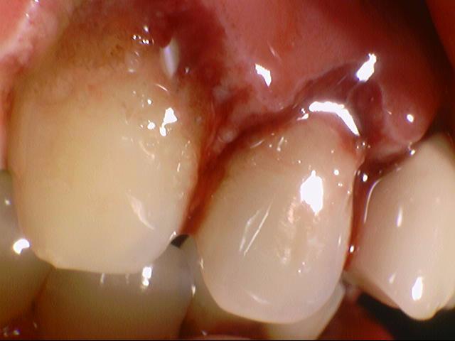 잇몸에서 피가 나요 잇몸치료에 대해 알려드려요 실제사례 및 비용은 관련 이미지 3