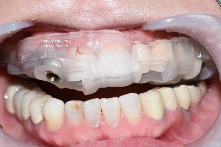 마포 임플란트가 너무 무서워요 하는 분들 잇몸절개하지 않는 네비게이션임플란트 소개해드립니다 관련 이미지 4