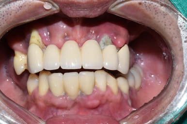 서울 중구 치과/이가 하나도 없는 환자의 치료방법/틀니, 풀아치임플란트, 전체 임플란트 등 관련 이미지 12