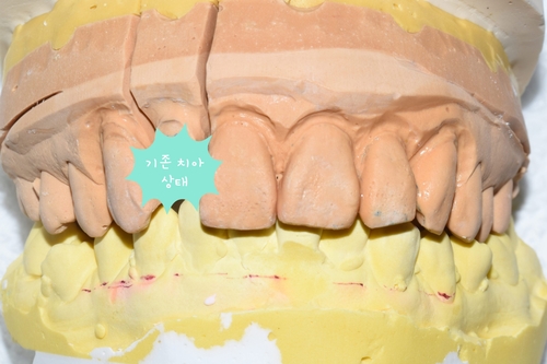[시청역/광화문/서대문]삐뚤삐뚤한 치아 무삭제라미네이트로 치아성형 관련 이미지 6