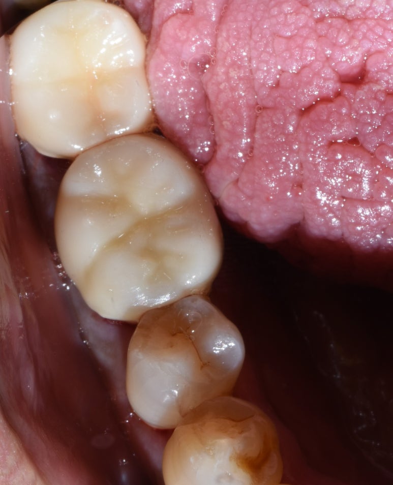 시청역치과/ "금니크라운이 보기싫은데 바꿀 수 있나요?" 관련 이미지 6