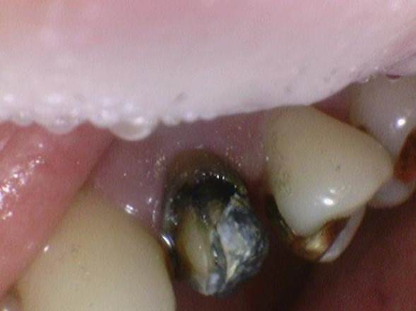 [서울역/광화문] 오래된 크라운에 음식물이 많이 껴요 &rarr;해결방법은? 관련 이미지 4