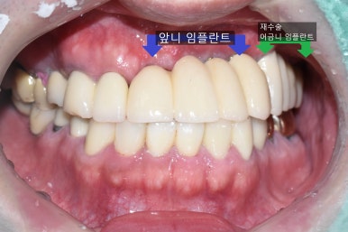 충정로 서울역 근처 고난도 & 재수술 임플란트 수술 치과 관련 이미지 5