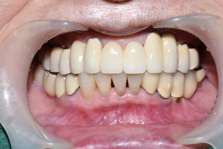 사용중인 틀니가 불편하다면? 임플란트와 틀니가 결합된 임플란트 틀니 추천 관련 이미지 8