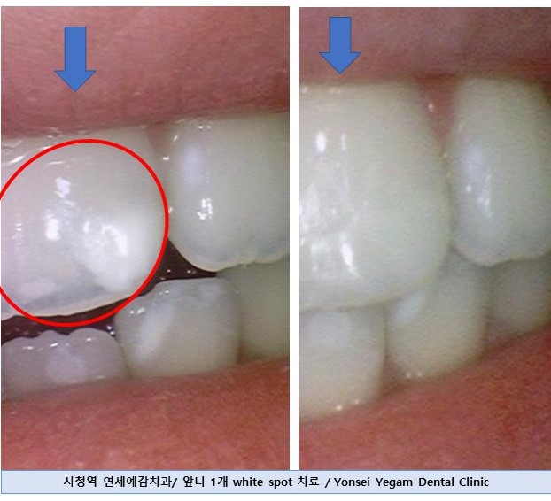 [서울역/시청역/치과] 화이트스팟, White spot, 반점치, 반상치, white stain, 탈회 치아의 레진치료 케이스 관련 이미지 3