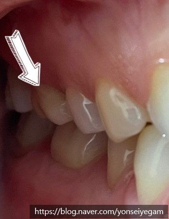 시청역치과 충치치료, 많이 썩었을 때? 신경치료에 대해 알아보아요 관련 이미지 7
