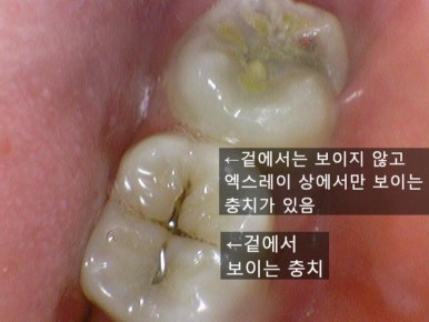 시청역 충정로 충치치료 치과 추천 관련 이미지 3
