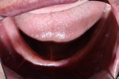 서울 중구 치과/이가 하나도 없는 환자의 치료방법/틀니, 풀아치임플란트, 전체 임플란트 등 관련 이미지 17