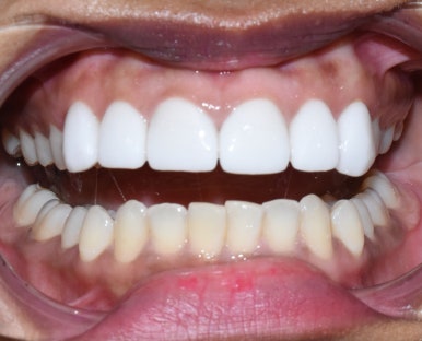 아주 하얀 치아를 만들고 싶어요 라미네이트케이스 및 비용 안내 관련 이미지 2