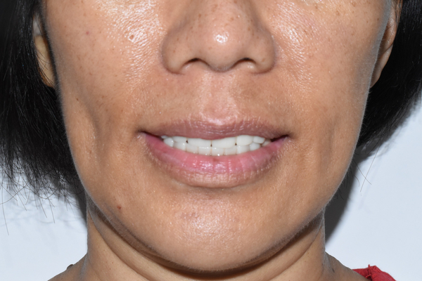 전체 임프란트를 하기 위해 홍콩에서 오신 홍콩인 환자분 관련 이미지 5