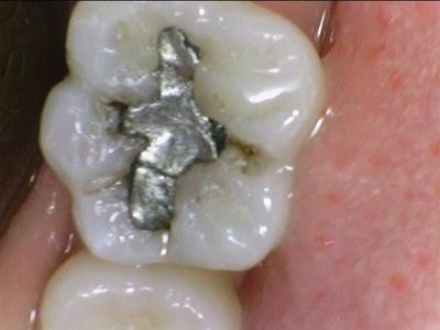 광화문/시청역"까만 아말감, 금니가 보기 싫다면?" 관련 이미지 1