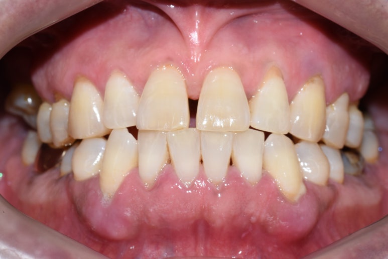 [서울시청역/남대문]어금니임플란트+상악동거상술(뼈이식):실제케이스 관련 이미지 7