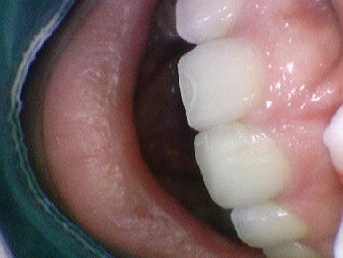 앞니깨짐 실제 치료 사례, 넘어져서 변색된 앞니 깨진 앞니 관련 이미지 5