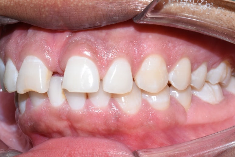 명동 가까운 치과 /외국인 흑인분의 매우 벌어진 앞니 치료 (빠른 부분교정(3개월)+라미네이트)/가격안내 관련 이미지 3