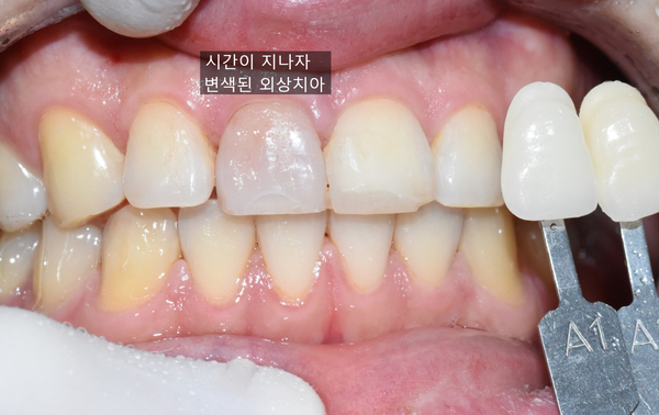 앞니깨짐 실제 치료 사례, 넘어져서 변색된 앞니 깨진 앞니 관련 이미지 7