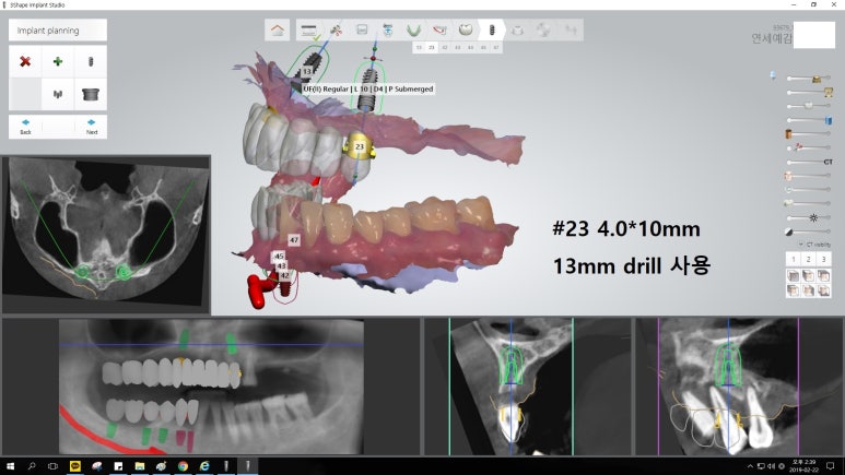 [남대문시장] 임플란트 조금 더 안아프고 간편하게 관련 이미지 9