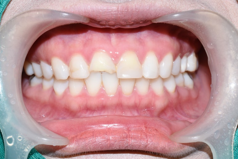 [광화문/연세예감치과] 앞니 치아가 파절되었다면? 앞니 부러짐.레진/크라운/임플란트 관련 이미지 4