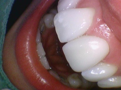 시청역 치과/ 신경이 죽은 치아의 변색 치료 위한 크라운 케이스&가격도 / 외국인 환자분이 눈물을 흘리셨어요 관련 이미지 2