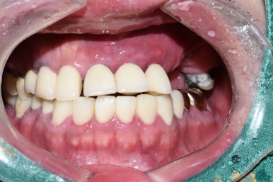 충정로 서울역 근처 고난도 & 재수술 임플란트 수술 치과 관련 이미지 2