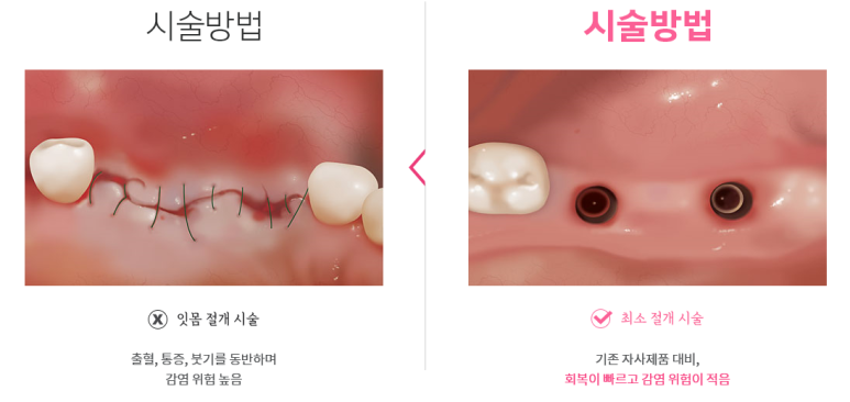 디지털임플란트 실제사례 알아보아요 관련 이미지 1