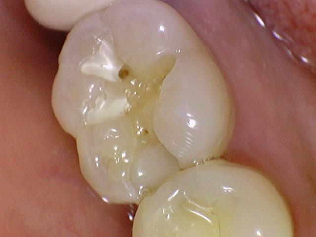 서울 인레이 유명한 치과 서울시청역치과 인레이에 대해 안내해드려요 관련 이미지 1