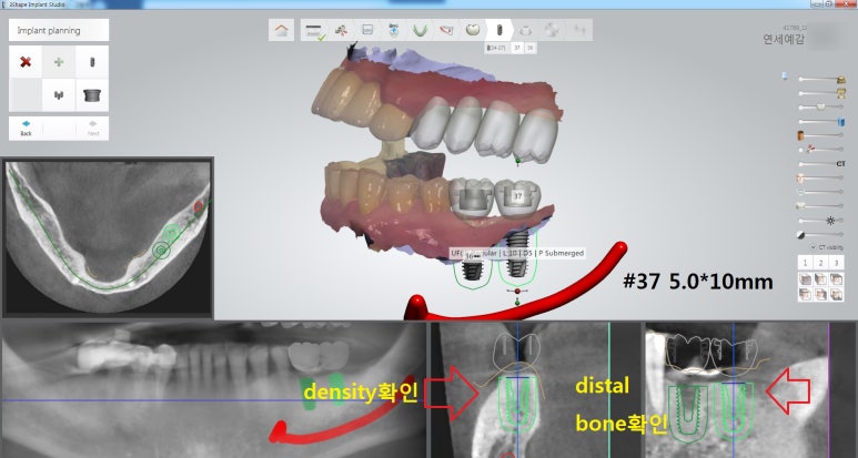 남대문시장 근처 치과 임플란트 연세.예감.치과 관련 이미지 11