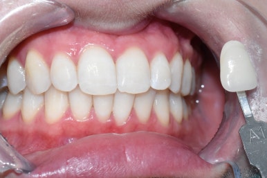 치아미백, 치과에서 하면 얼마나 오래갈까? 궁금하시다면, 실제사례 바탕으로 알아보아요 지속,유지 관련 이미지 8