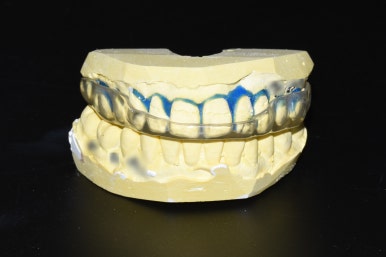 이갈이원인 증가요인 이갈이 치료방법 비용 관련 이미지 5