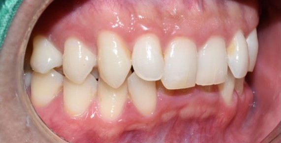 [서울시청역치과] 옥니 간단한 해결방법 찾고 계신가요? &rarr;이벤트안내 관련 이미지 4