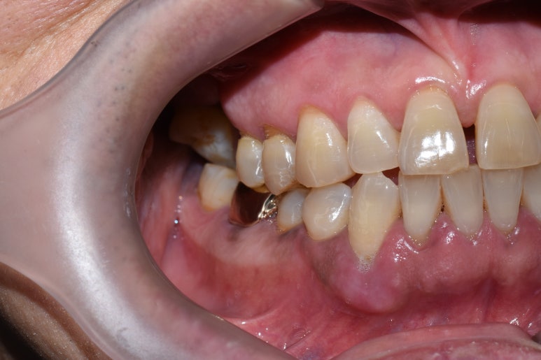 [서울시청역/남대문]어금니임플란트+상악동거상술(뼈이식):실제케이스 관련 이미지 6