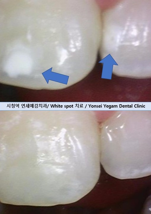 [서울역/시청역/치과] 화이트스팟, White spot, 반점치, 반상치, white stain, 탈회 치아의 레진치료 케이스 관련 이미지 1