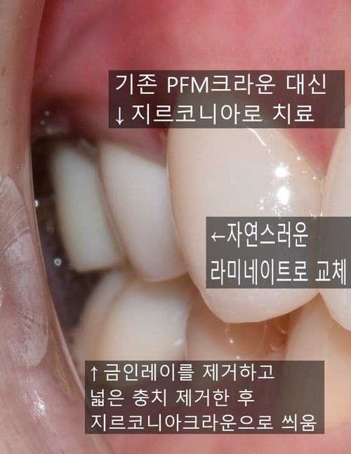 시청역치과/ "금니크라운이 보기싫은데 바꿀 수 있나요?" 관련 이미지 8