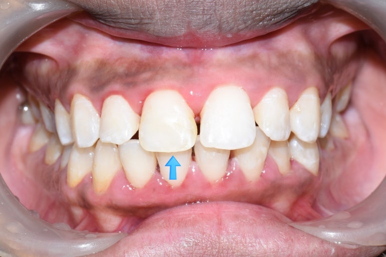 [서울역/충정로/치과] 화이트스팟+충치가 결합된 치아의 resin레진치료 케이스 관련 이미지 5