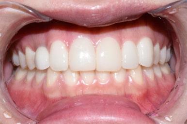 [광화문/시청역 치과]임플란트+크라운 +무삭제 라미네이트 복합 혼합 "6개 앞니 케이스" 소개/라미네이트가격 관련 이미지 3