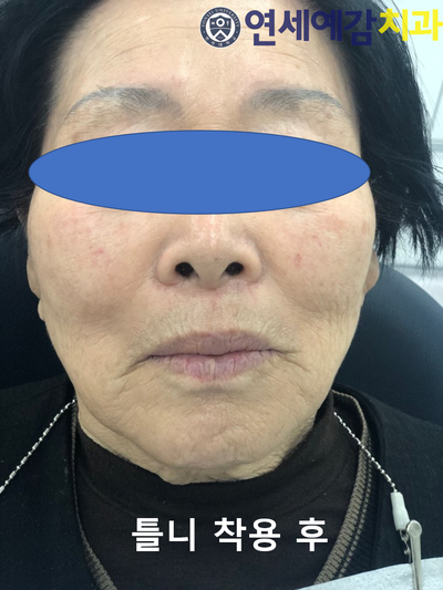 남대문시장가까운치과, 명동,서울역&용산가까운치과, 틀니치료 사례 관련 이미지 7