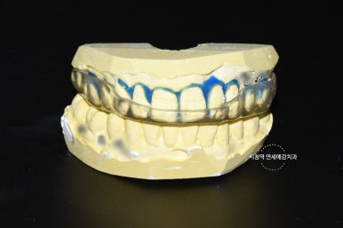 이갈이로 인한 치아 닳음 치료방법 비용 알아보아요 관련 이미지 4