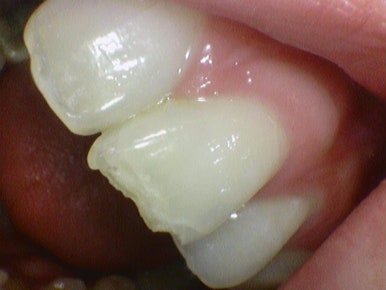 깨진 치아 레진치료 방법 실제사진 관련 이미지 4