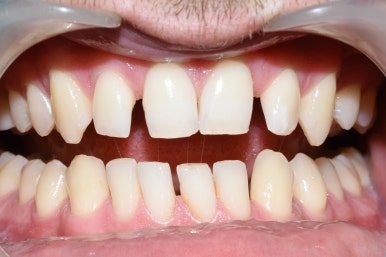 왜소치 치아사이틈 막기 올해는 치료받으세요! [무삭제라미네이트 케이스] 관련 이미지 5