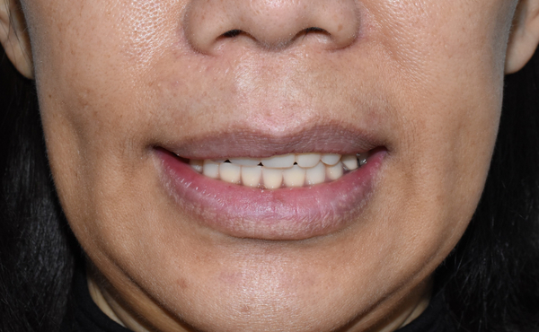 전체 임프란트를 하기 위해 홍콩에서 오신 홍콩인 환자분 관련 이미지 4