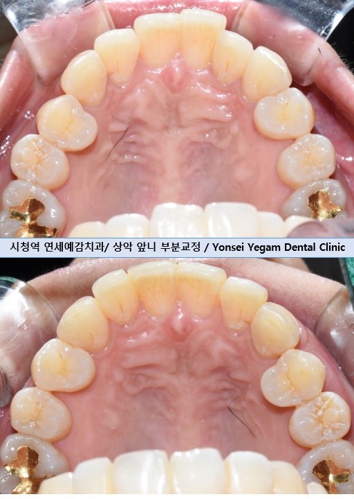 오래전 교정한 치아가 틀어져서 부분 재교정 케이스, 비용가격[광화문/서울역/치과] 관련 이미지 5