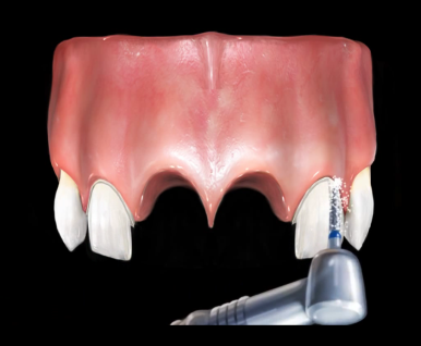 넘어져서 또는 부딪혀서 앞니 아주 많이 부러진 경우, 시청역치과 실제 앞니브릿지케이스 관련 이미지 6