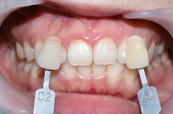 [서울시청역/광화문]치과에서 하는 원데이 치아미백, 연세예감치과에서 알려드려요 관련 이미지 6