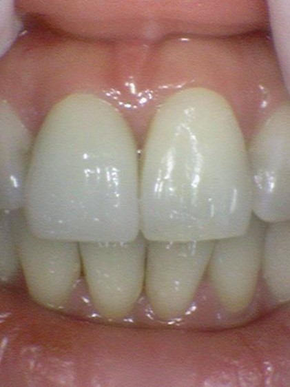 치아가 충치나 크랙으로 지르코니아 크라운을 해야한다면? 구강스캔사용치과의 지르코니아크라운 설명 관련 이미지 1