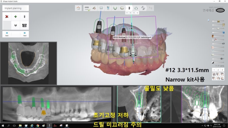 시청역 광화문  최소절개 또는 비절개로 가능한 네비게이션 임플란트 유명한 치과 내비게이션소개드려요 관련 이미지 8